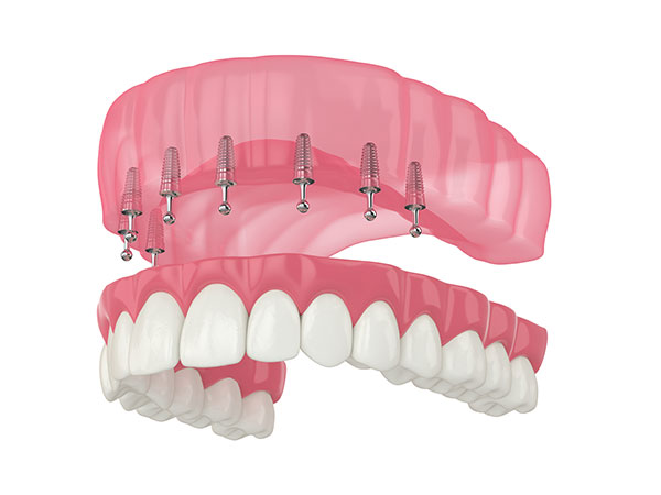 illustration of snap-in dentures
